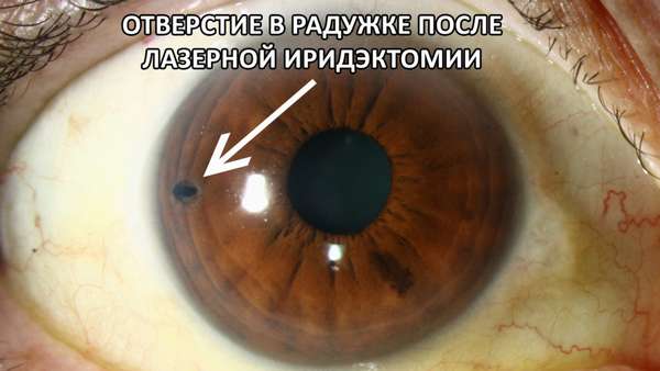 Открытоугольная глаукома 1 и 2 степени: причины, симптомы, лечение и профилактика